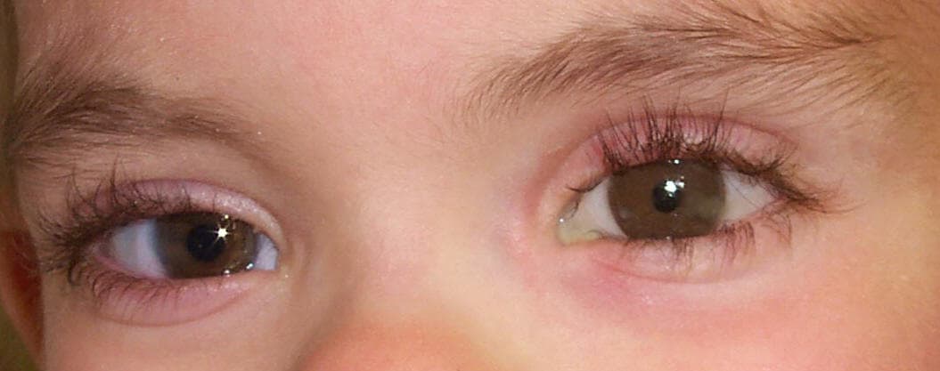 Anophthalmic reconstruction result, lateral gaze