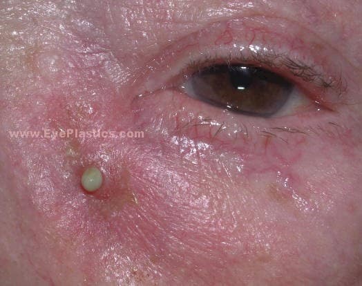 Acute dacryocystitis showing infected lacrimal sac