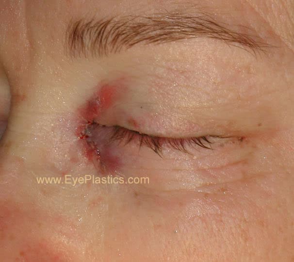 DCR surgery — the opened lacrimal sac and new passage into the nose