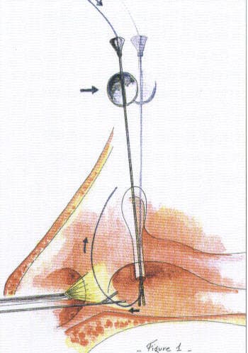 Canalicular laceration at presentation