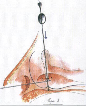 Identifying the cut ends of the canaliculus