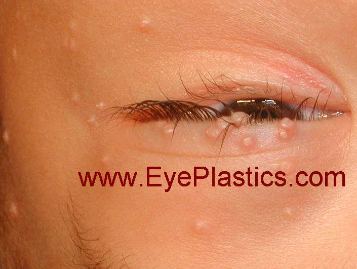 Periocular and eyelid molluscum contagiosum &mdash; umbilicated papules