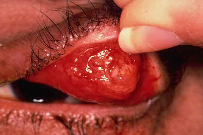 Sebaceous carcinoma upper eyelid with lid retracted showing conjunctival spread