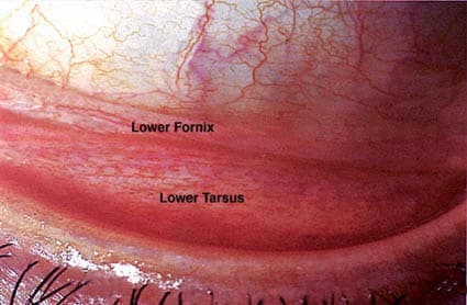 Symblepharon band restricting eyelid and eye movement