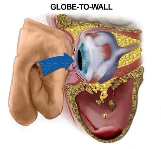 Globe-to-wall theory of orbital floor fracture