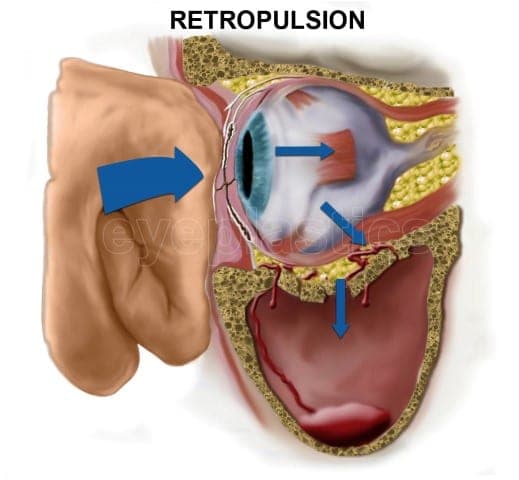 Retropulsion (hydraulic) theory of orbital floor fracture