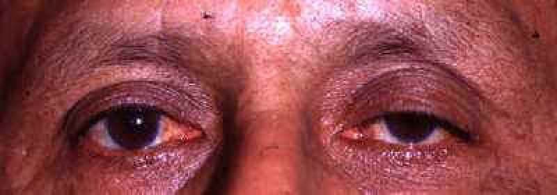 Low lid margin with a high eyelid crease, both sides — involutional (aponeurotic) ptosis