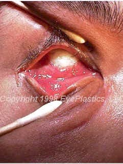 Anophthalmic socket changes affecting prosthesis fit