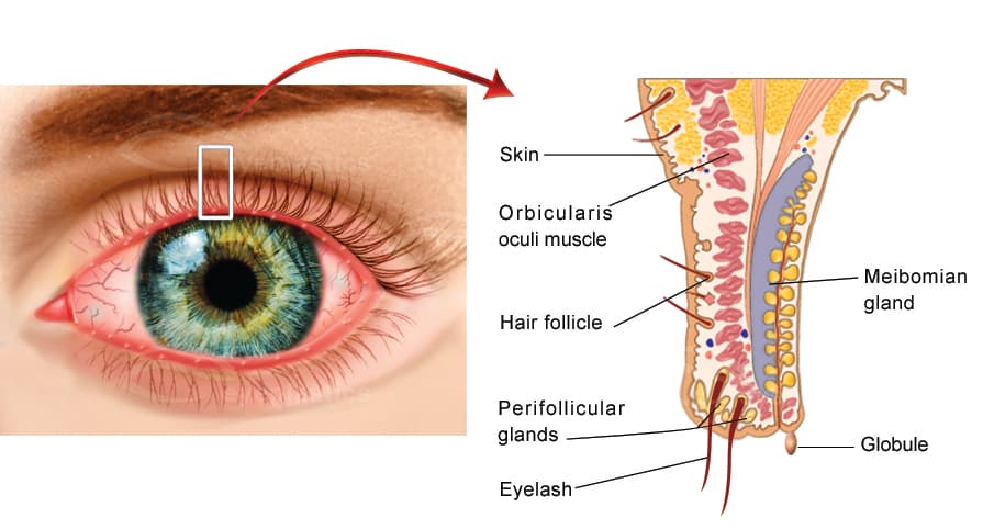 Meibomian gland dysfunction with an inspissated oil globule