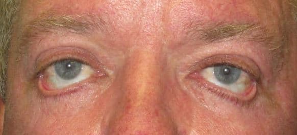 Ectropion of the lower eyelid after blepharoplasty