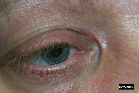Medial canthal web after eyelid surgery — vertical fold of skin across the inner corner