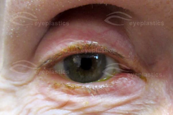Canaliculitis of the right lower eyelid — erythema and swelling over the medial canaliculus