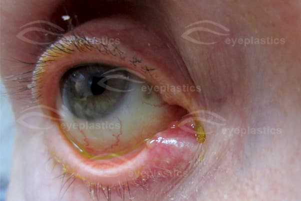 Pouting punctum with discharge — right lower eyelid
