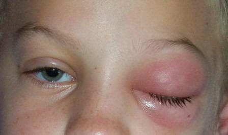 Preseptal cellulitis with eyelid swelling and redness