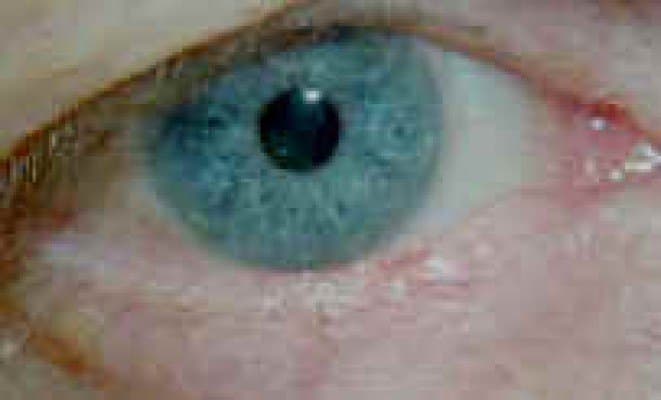 Basal cell carcinoma involving the lower-eyelid margin