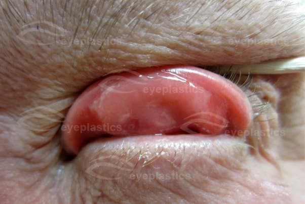 Close-up of the lax upper eyelid everting — soft rubbery tarsus