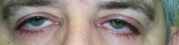 Lash ptosis — downward-pointing upper lashes
