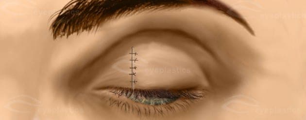 Healed upper eyelid after wedge resection with a fine vertical seam