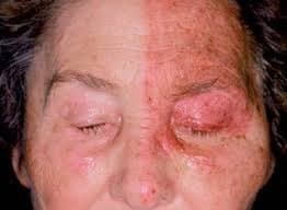 Herpes zoster ophthalmicus — unilateral dermatomal rash with eyelid swelling