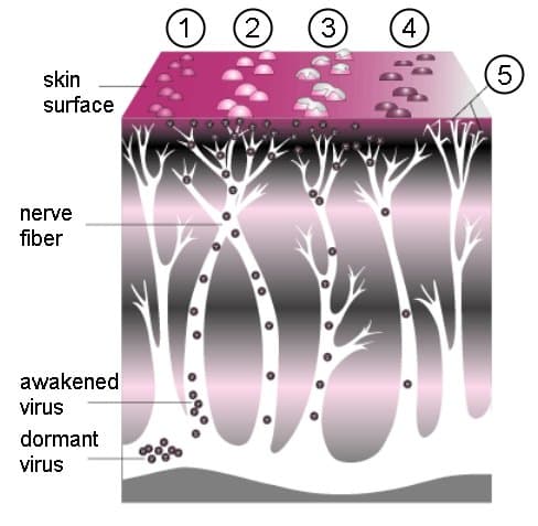 Course of shingles — papule to vesicle to crust