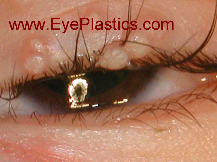 Molluscum contagiosum — periocular distribution