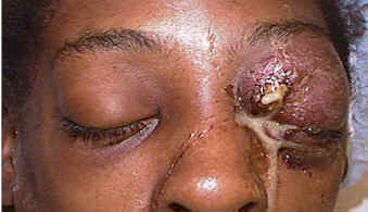 Orbital cellulitis — clinical photograph