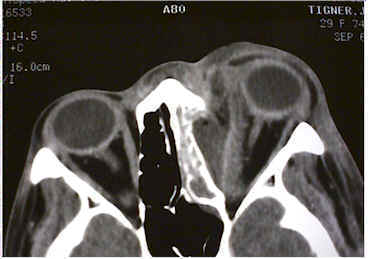 Orbital infection — CT imaging
