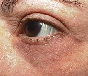 Laser resurfacing — pre-operative assessment