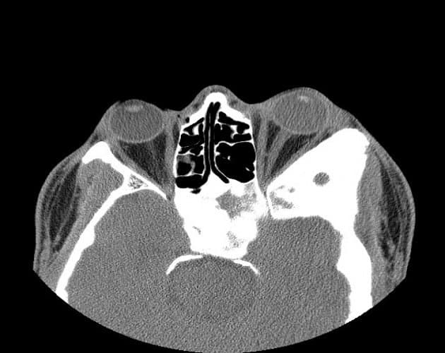 CT scan — fibrous dysplasia expanding the orbital bone, with the characteristic hazy “ground-glass” matrix