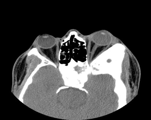 CT of orbital fibrous dysplasia — bony reshaping of the orbit