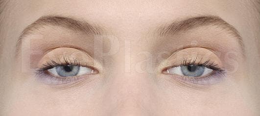 Bilateral ptosis showing drooping of both upper eyelids