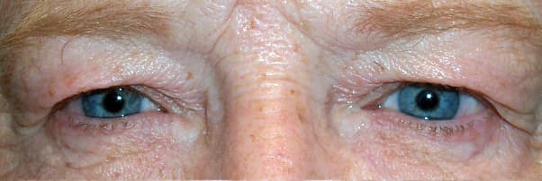 Dermatochalasis — excess upper eyelid skin hooding over a normal lid margin