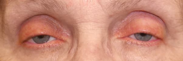 Ptosis — both upper eyelid margins droop low across the eyes