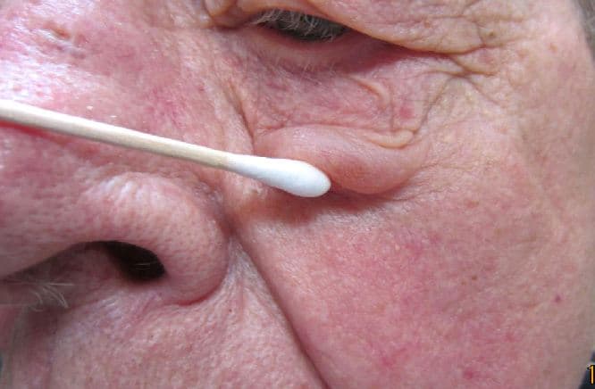 Ocular rosacea — eyelid margin changes