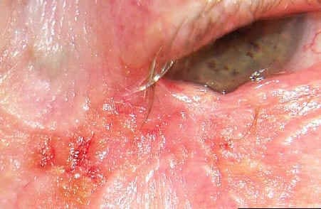 Sebaceous gland carcinoma at the medial canthal area