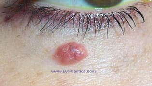 Basal cell carcinoma of the lower eyelid margin