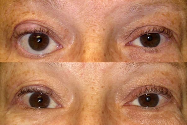 Thyroid eye disease appearance before and after treatment
