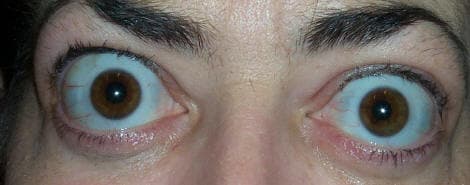 Thyroid eye disease showing lid retraction and proptosis