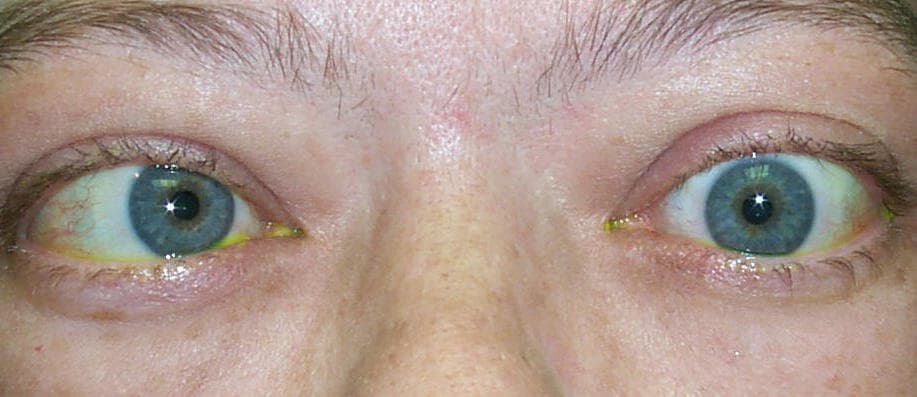 Thyroid eye disease with strabismus and double vision