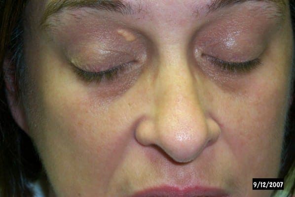Xanthelasma plaques along the medial eyelid