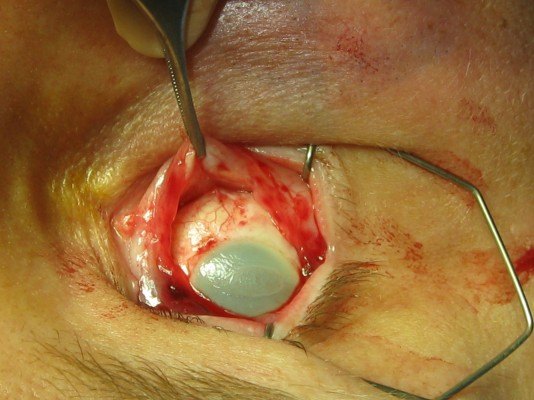 Evisceration — Actual Surgery Photographs — slide 1 of 15