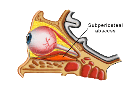 Orbital abscess — anatomic diagram