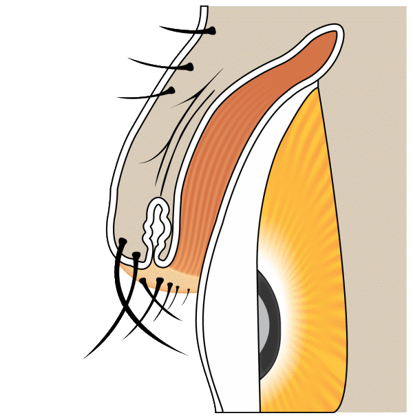 Diagram of trichiasis with lashes misdirected toward the cornea